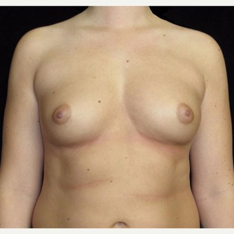 21 year old woman with asymmetry treated with Breast Augmentation before 3092590