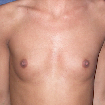 18-24 year old woman treated with Breast Augmentation before 3136568