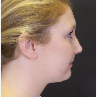 25-34 year old woman treated with Chin Liposuction after 3065529
