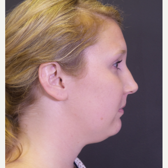 25-34 year old woman treated with Chin Liposuction before 3065529