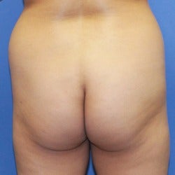 35-44 year old woman treated with Brazilian Butt Lift before 1860555