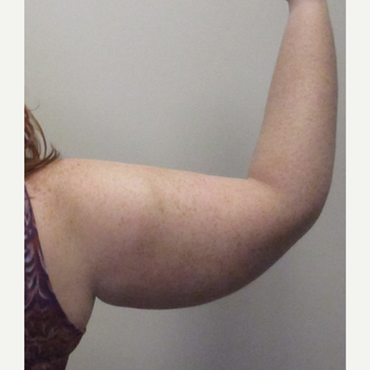 25-34 year old woman treated with Arm Lift before 3253398