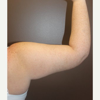 25-34 year old woman treated with Arm Lift after 3253398