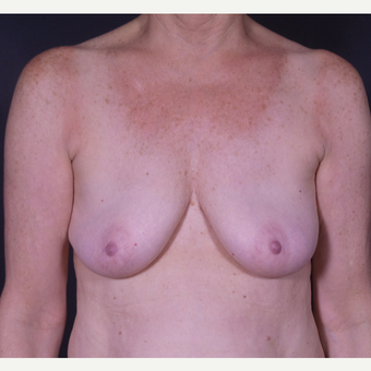 55-64 year old woman treated with Breast Implant Removal after 3065570