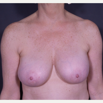 55-64 year old woman treated with Breast Implant Removal before 3065570