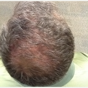 45-54 year old man treated with Hair Loss Treatment after 3506357