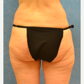 57 year old female addressing gradual weight gain issues in thighs and buttock before 3731713
