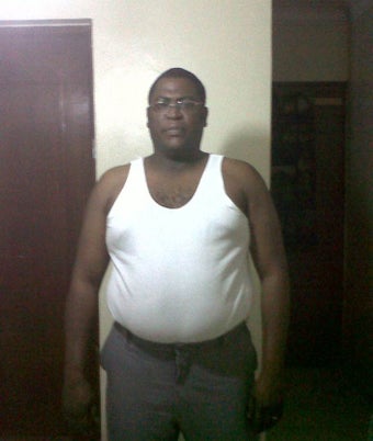 32 years old treated with sleeve gastrectomy before 1239663