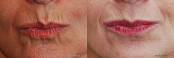 Botox before 1442057