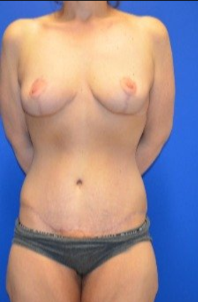 35-44 year old woman treated with Mommy Makeover after 3180294