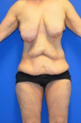 35-44 year old woman treated with Mommy Makeover before 3180294