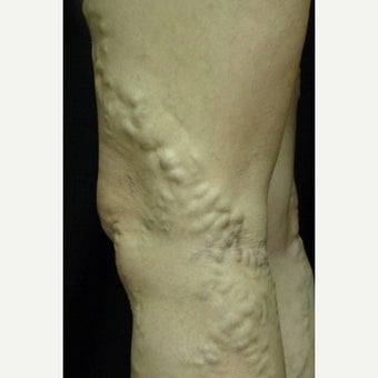 Bulging leg veins treated with Sclerotherapy before 1672460