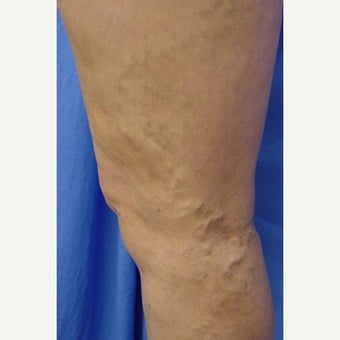 Bulging leg veins treated with Sclerotherapy after 1672460