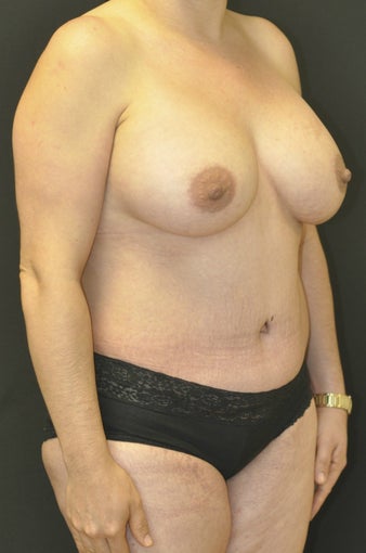 35-44 year old woman treated with Mommy Makeover after 1232528