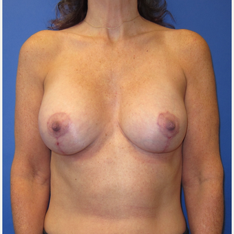 45-54 year old woman treated with Breast Lift with Implants (339cc) after 3760031