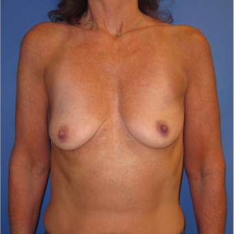 45-54 year old woman treated with Breast Lift with Implants (339cc) before 3760031