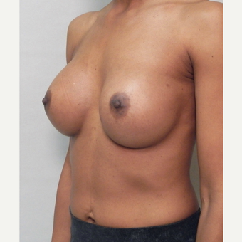 Breast Implants after 3241614