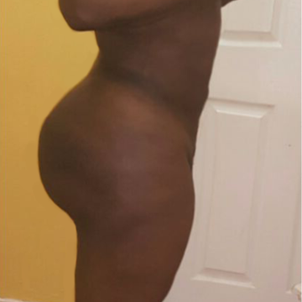 25-34 year old woman treated with Brazilian Butt Lift after 3723923