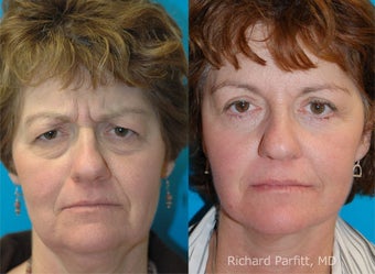 Blepharoplasty and Facelift before 1465041