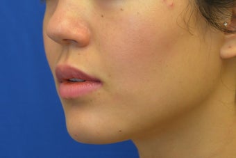 Dysport for Jaw Slimming 1008141