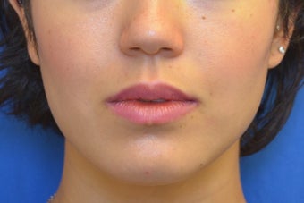 Dysport for Jaw Slimming after 1008141