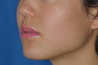 Dysport for Jaw Slimming 1008141