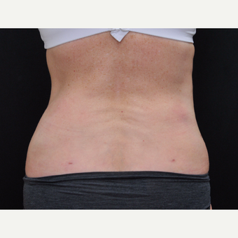 55-64 year old woman treated with Laser Liposuction after 3775885