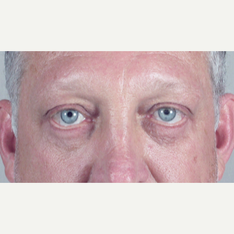 45-54 year old man treated with Eyelid Surgery after 3213272