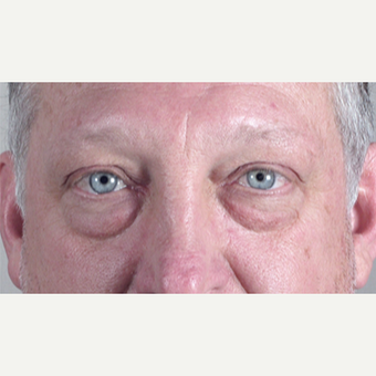 45-54 year old man treated with Eyelid Surgery before 3213272