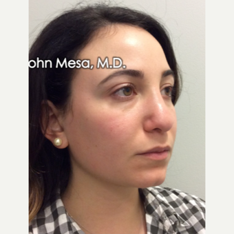 18-24 year old woman treated with Buccal Fat Removal before 3769121