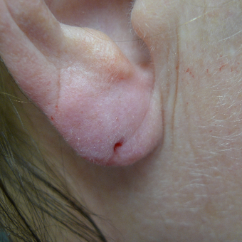 Juvederm for ear lobe restoration after 3033841