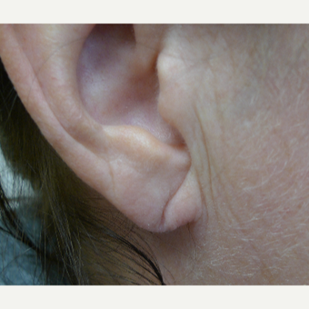 Juvederm for ear lobe restoration before 3033841