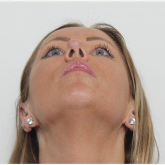 35-44 year old woman treated with Rhinoplasty before 3406145