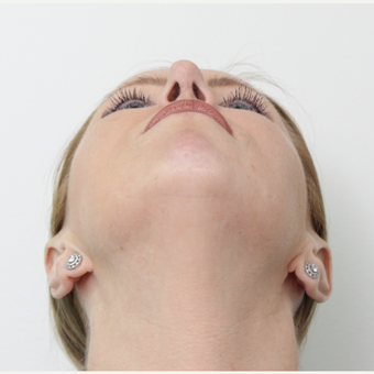 35-44 year old woman treated with Rhinoplasty after 3406145