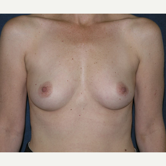 45-54 year old woman treated with Breast Implants before 3455532