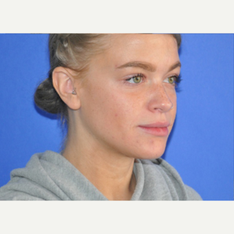 25-34 year old woman treated with Eye Bags Treatment after 3225572
