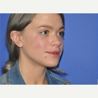 25-34 year old woman treated with Eye Bags Treatment before 3225572