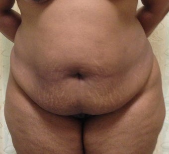 37 Year Old Woman Treated with a Tummy Tuck before 1193215