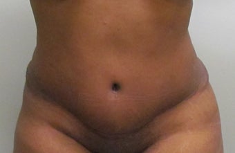 37 Year Old Woman Treated with a Tummy Tuck after 1193215