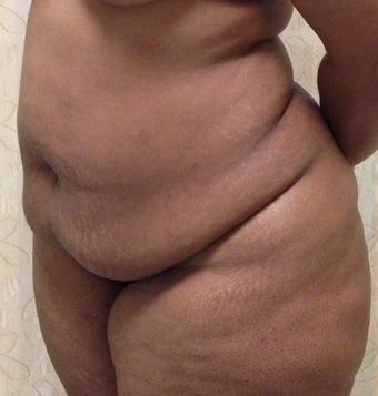 37 Year Old Woman Treated with a Tummy Tuck 1193215