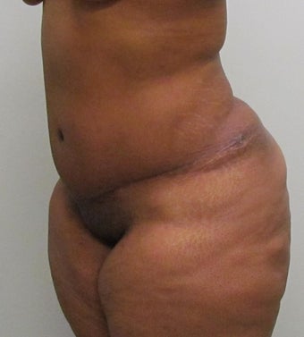37 Year Old Woman Treated with a Tummy Tuck 1193215