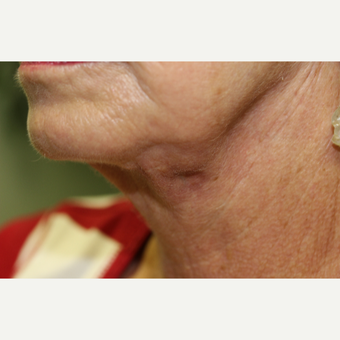 65-74 year old woman treated with Neck Lift after 3837254