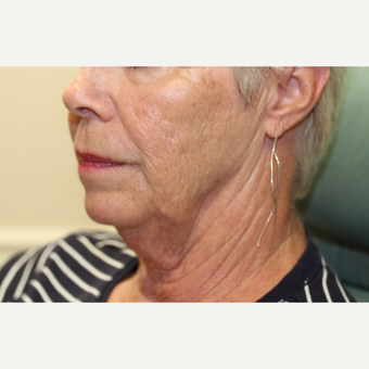 65-74 year old woman treated with Neck Lift before 3837254