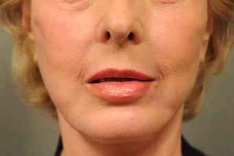 64 Year Old Female with Deep Lip Lines and Asymmetry to Lips after 686374