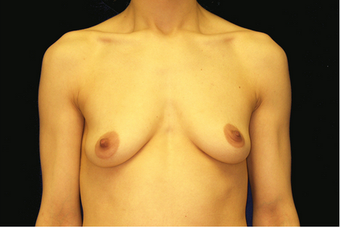 breast augmentation and mastopexy before 391312