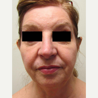 Facelift for this 58 Year Old Woman before 3043329