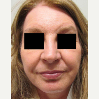Facelift for this 58 Year Old Woman after 3043329