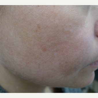 Melasma- improved with lasers, SPF and HQ after 3260196
