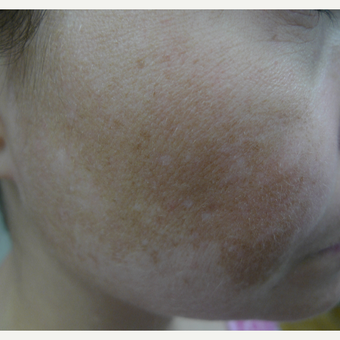 Melasma- improved with lasers, SPF and HQ before 3260196