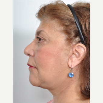 55-64 year old female treated with Facelift and Upper/Lower Blepharoplasty after 3246630